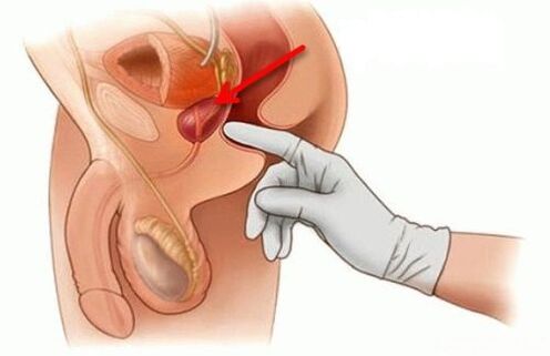 prostatos masažas sergant prostatitu